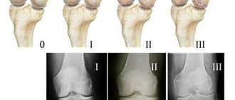 показания к приему терафлекс адванс
