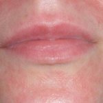 Покраснение кожи лица