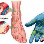 Polyneuropathy