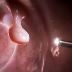 Полип - доброкачественное образование в желчном пузыре