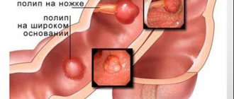 Полипы в желудке