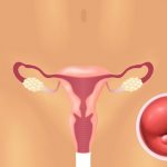 Посмотрим, что собой представляют кисты эндоцервикса и нужно ли их лечить...