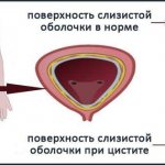 Surface of the mucous membrane with cystitis