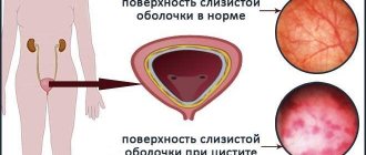 Поверхность слизистой оболочки при цистите