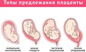 Предлежание плаценты при беременности. Что это, от чего бывает, чего нельзя делать. Клинические рекомендации