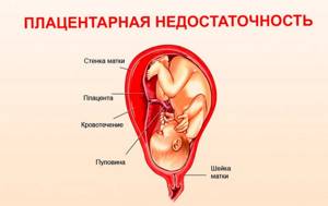предлежание плаценты при беременности