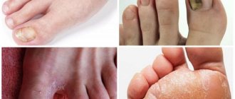 The drug is used in the treatment of fungal infections of the feet