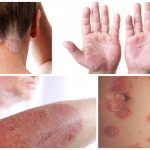 Препарат применяют в терапии заболеваний кожи