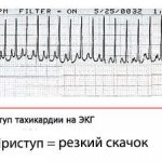 Причины учащенного сердцебиения
