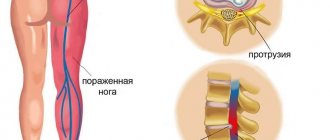 causes of inflammation of the sciatic nerve
