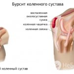 Признаки бурсита коленного сустава