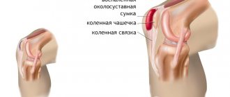 Признаки бурсита коленного сустава