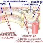Признаки межреберной невралгии