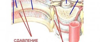 Признаки межреберной невралгии