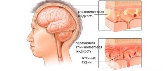 Signs of serous meningitis