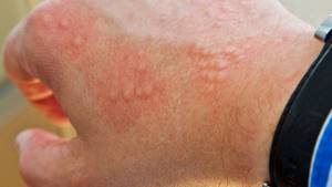 Проявления аллергического дерматита