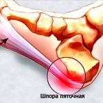 Пяточная шпора