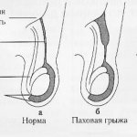 Development of inguinal hernia