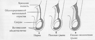 Развитие паховой грыжи