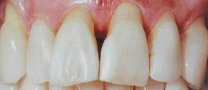 Рецессия десны и значительное оголение корней фронтальных зубов