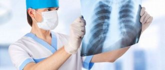 рентген-диагностика милиарного туберкулеза