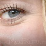 Ретиноевая мазь от морщин