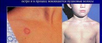 Розовые пятна