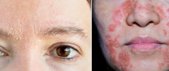 Seborrhea on the face of two types