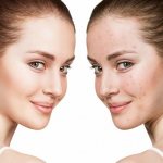 simple sulfur ointment what is it for?