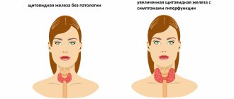 щитовидная железа гиперфункция.png