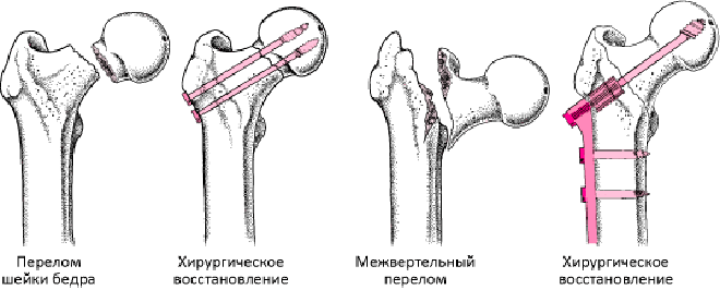 Перелом шейки бедренной кости карта вызова смп
