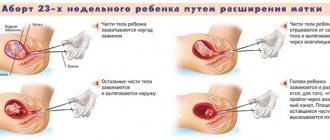 схема проведения аборта