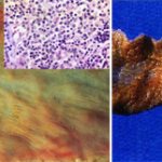 Симптомы брюшного тифа