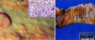 Symptoms of typhoid fever