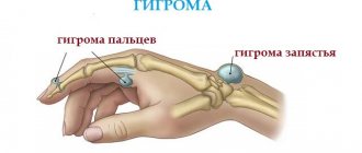 симптомы гигромы