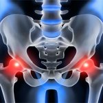 Symptoms and treatment of arthrosis of the hip joint