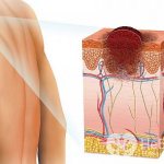 Симптомы карциномы