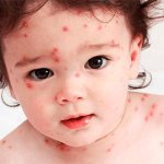 Симптомы краснухи