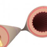 Синглон инструкция отзывы