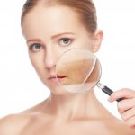 Системная красная волчанка (СКВ)