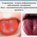 Скарлатина у взрослых. Симптомы и лечение, профилактика, признаки, как передается