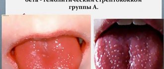 Scarlet fever in adults. Symptoms and treatment, prevention, signs, how it is transmitted