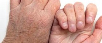 Dry skin on hands