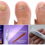 Состав и описание препарата Микозан