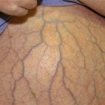 Splenomegaly (enlarged spleen)