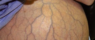 Splenomegaly (enlarged spleen)