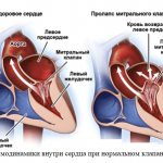 Сравнение гемодинамики внутри сердца при нормальном клапане и ПМК