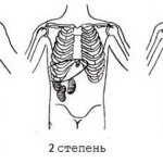 Degrees of nephroptosis