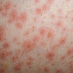 Стрептококковая инфекция на коже