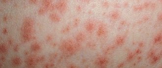 Streptococcal skin infection